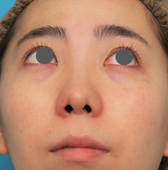 症例写真,非常に鼻の下が長い人に対して人中短縮と鼻柱への耳介軟骨移植を行った症例写真,After(6ヶ月後),ba_hanashita003_b02.jpg
