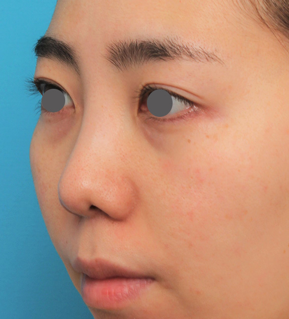 症例写真,非常に鼻の下が長い人に対して人中短縮と鼻柱への耳介軟骨移植を行った症例写真,After(6ヶ月後),ba_hanashita003_b03.jpg
