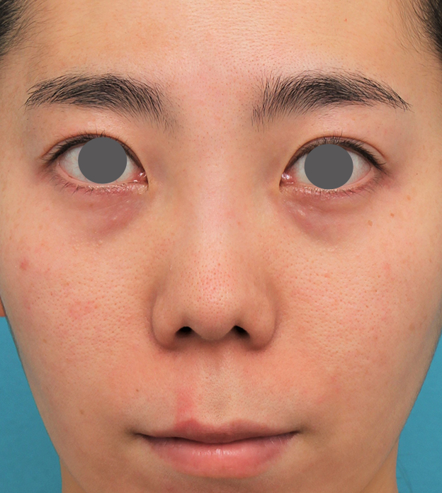 症例写真,非常に鼻の下が長い人に対して人中短縮と鼻柱への耳介軟骨移植を行った症例写真,手術前,mainpic_hanashita003a.jpg