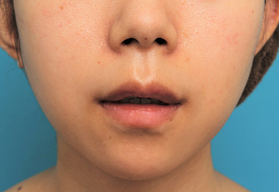 症例写真,上唇の真ん中の出っ張り(上唇結節)を手術で切除して目立たなくした症例写真,After(6ヶ月後),ba_usuku014_b02.jpg