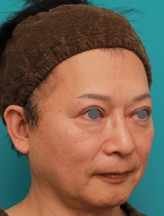 症例写真,50代の男性の鼻にシリコンプロテーゼを入れて鼻筋を通した症例写真,After(2ヶ月後),ba_ryubi1056_b02.jpg