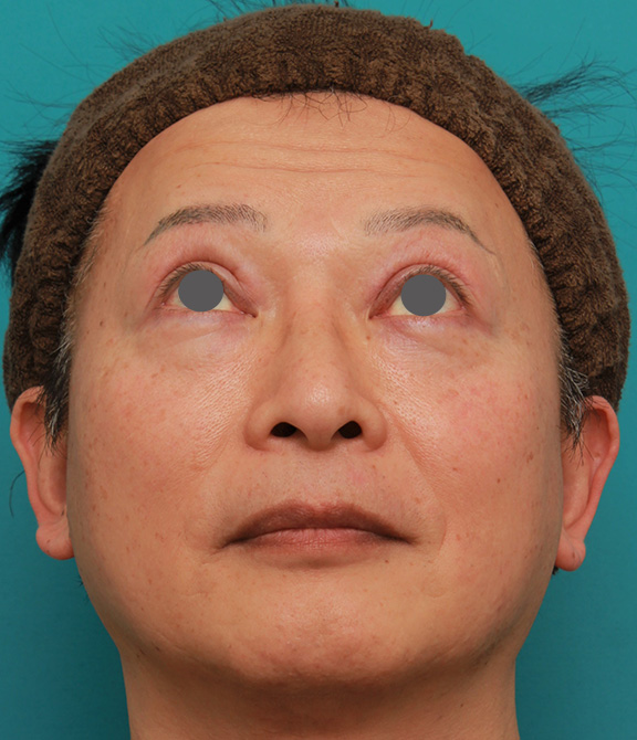 症例写真,50代の男性の鼻にシリコンプロテーゼを入れて鼻筋を通した症例写真,After(2ヶ月後),ba_ryubi1056_b03.jpg