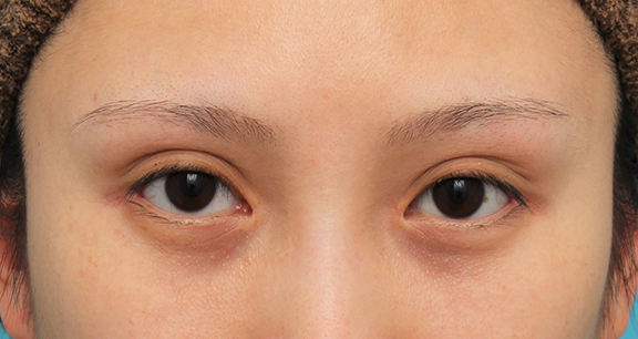 目頭切開+目尻切開で目の横幅を広げた症例写真,After（6ヶ月後）,ba_megashira061_a01.jpg