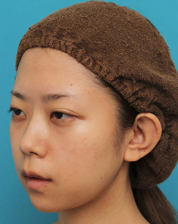あご形成(シリコンプロテーゼ),引っ込んでいる顎をシリコンプロテーゼで前方に出した20代女性の症例写真,After(6ヶ月後),ba_ago020_b02.jpg