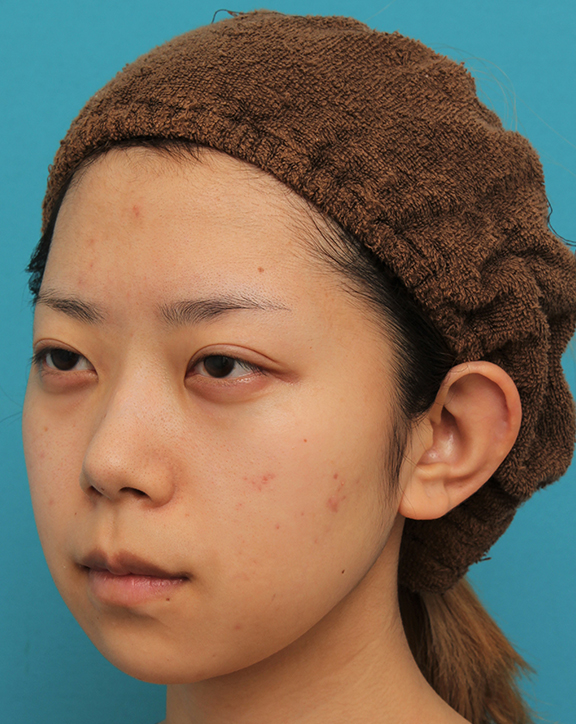 あご形成(シリコンプロテーゼ),引っ込んでいる顎をシリコンプロテーゼで前方に出した20代女性の症例写真,Before,ba_ago020_b02.jpg