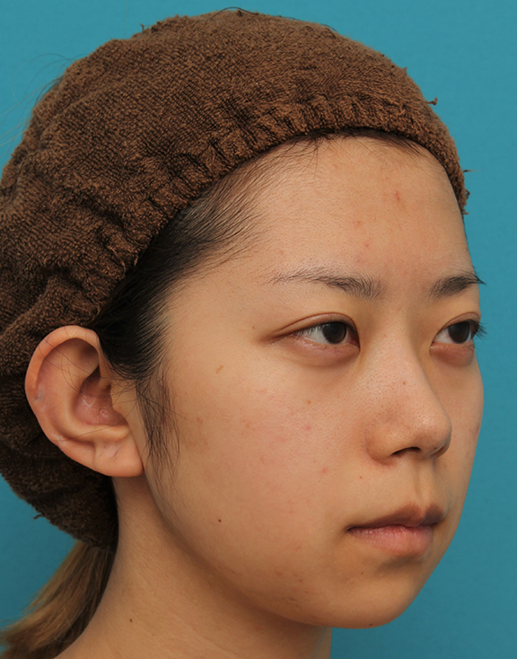 あご形成(シリコンプロテーゼ),引っ込んでいる顎をシリコンプロテーゼで前方に出した20代女性の症例写真,Before,ba_ago020_b04.jpg