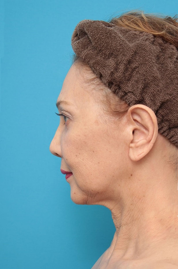 症例写真,ネックリフト(首のたるみ取り手術)の症例写真,Before,ba_necklift001_b02.jpg