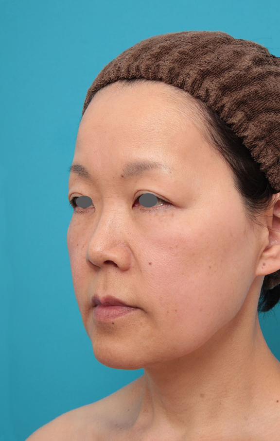 ミニフェイスリフト(頬のたるみ取り),ミニフェイスリフト ダウンタイム時期安定期の症例写真,Before,ba_minilift008_b02.jpg