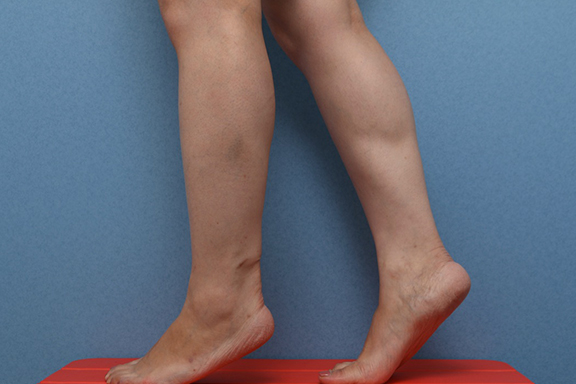 症例写真,ふくらはぎボツリヌストキシン注射の症例写真,After(3ヶ月後),ba_leg012_b02.jpg