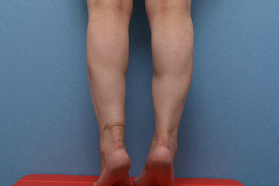 症例写真,ふくらはぎボツリヌストキシン注射の症例写真,After(3ヶ月後),ba_leg012_b04.jpg