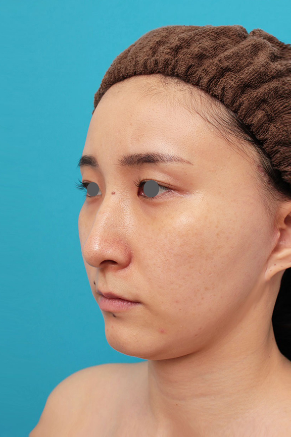 ミニフェイスリフト(頬のたるみ取り),ミニフェイスリフト(頬のたるみ取り)・脂肪吸引(頬、あご下)の症例写真,After(6ヶ月後),ba_minilift009_b02.jpg