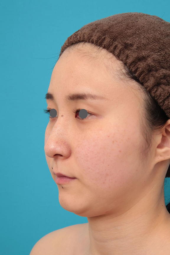 ミニフェイスリフト(頬のたるみ取り),ミニフェイスリフト(頬のたるみ取り)・脂肪吸引(頬、あご下)の症例写真,Before,ba_minilift009_b02.jpg