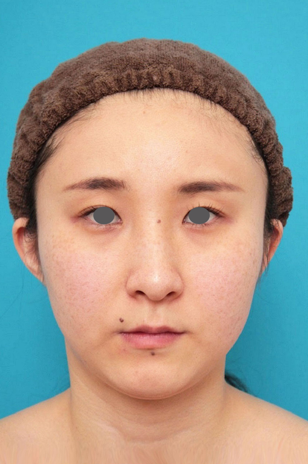 ミニフェイスリフト(頬のたるみ取り),ミニフェイスリフト(頬のたるみ取り)・脂肪吸引(頬、あご下)の症例写真,施術前,mainpic_minilift009a.jpg