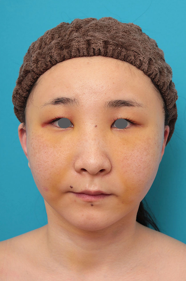 ミニフェイスリフト(頬のたるみ取り),ミニフェイスリフト(頬のたるみ取り)・脂肪吸引(頬、あご下)の症例写真,1週間後,mainpic_minilift009b.jpg