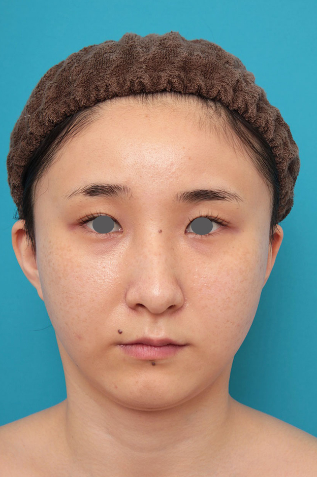 ミニフェイスリフト(頬のたるみ取り),ミニフェイスリフト(頬のたるみ取り)・脂肪吸引(頬、あご下)の症例写真,1ヶ月後,mainpic_minilift009c.jpg