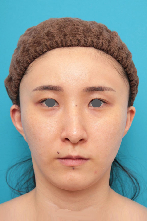 ミニフェイスリフト(頬のたるみ取り),ミニフェイスリフト(頬のたるみ取り)・脂肪吸引(頬、あご下)の症例写真,6ヶ月後,mainpic_minilift009d.jpg