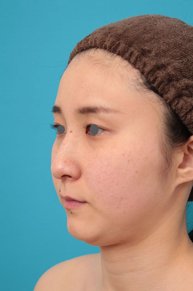 ミニフェイスリフト(頬のたるみ取り),ミニフェイスリフト(頬のたるみ取り)・脂肪吸引(頬、あご下)の症例写真,施術前,mainpic_minilift009e.jpg