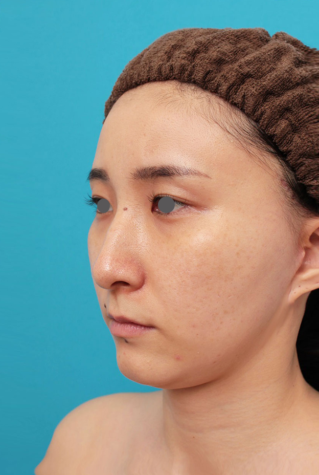 ミニフェイスリフト(頬のたるみ取り),ミニフェイスリフト(頬のたるみ取り)・脂肪吸引(頬、あご下)の症例写真,6ヶ月後,mainpic_minilift009h.jpg