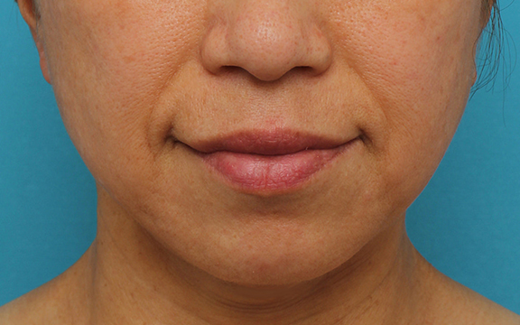 症例写真,ボツリヌストキシン注射(フェイスライン・口角リフト)の症例写真,After(3ヶ月後),ba_botox_lift001_b01.jpg