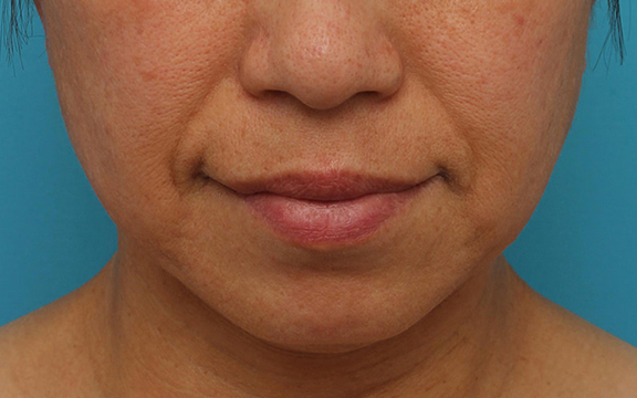 症例写真,ボツリヌストキシン注射(フェイスライン・口角リフト)の症例写真,Before,ba_botox_lift001_b01.jpg