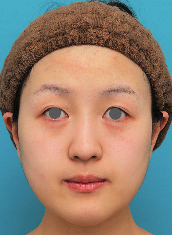 バッカルファット除去手術を行った20代女性の症例写真,After（6ヶ月後）,ba_buccalfat021_a01.jpg