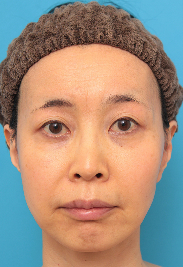 ミディアムフェイスリフト,ミディアムフェイスリフトでたるみのリフトアップをした50代女性の症例写真,6ヶ月後,mainpic_mediumlift012d.jpg