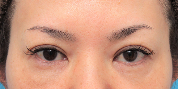 症例写真,非常に分厚い上まぶたに対してたるみ取り手術を行った40代女性症例写真,After(6ヶ月後),ba_tarumi016_b01.jpg