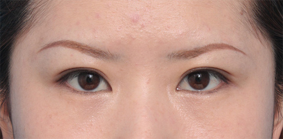 症例写真,埋没法で平行型二重を作った症例写真,After(メイクあり)<br/>
(1ヶ月後),
