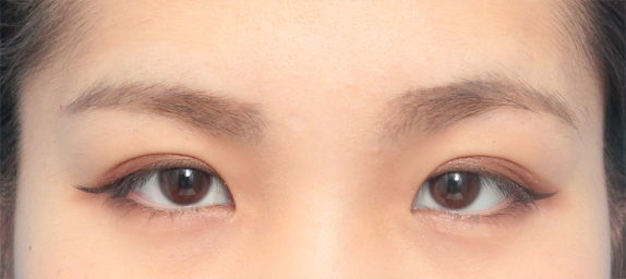 症例写真,二重まぶた・埋没法 術後3ヶ月の女性の症例写真,After(メイクあり)<br/>
(3ヶ月後),