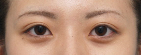 二重まぶた・埋没法の症例 幅の狭い平行型の二重になった20代女性,After（目を開いた状態）,ba_maibotsu18_a01.jpg