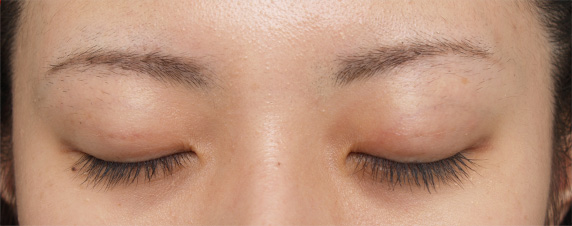 症例写真,二重まぶた・埋没法の症例 幅の狭い平行型の二重になった20代女性,After(目を閉じた状態)<br/>
(1週間後),