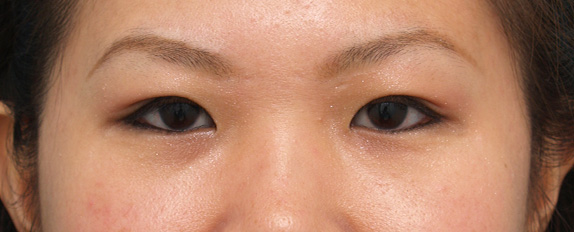 症例写真,二重まぶた・埋没法の症例 その人に一番自然で似合う二重瞼をご提案,After(メイクあり)<br/>
(1週間後),