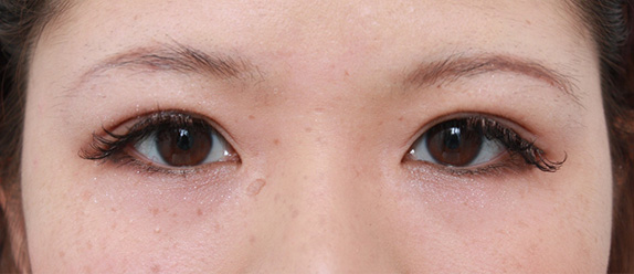 症例写真,埋没法でちょっと広めの平行型二重をつくった方の症例写真,After(メイクあり),