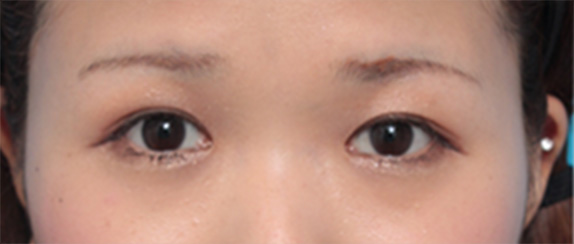 症例写真,埋没法で6mmの末広型ナチュラル二重にした症例写真,After(メイクあり)<br/>
(1ヶ月後),