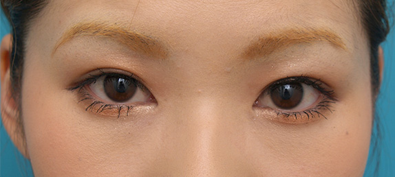 症例写真,埋没法で幅の狭い平行型二重を作った症例写真,After(メイクあり)<br/>
(1週間後),