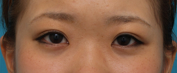 症例写真,埋没法で幅の狭い平行型二重をつくった症例写真,After(メイクあり)<br/>
(6ヶ月後),
