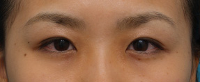 二重まぶた・埋没法,アイプチで被れた目に埋没法で二重を作った症例写真,After(メイクあり)<br/>
(1ヶ月後),