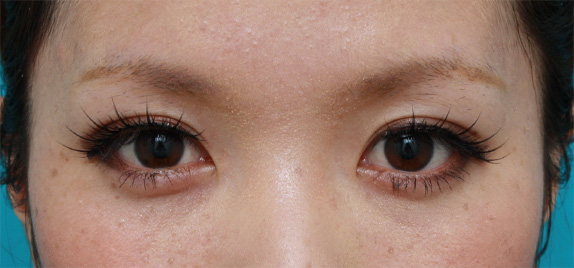 症例写真,目の左右差を両目の埋没法で修正した症例写真,After(メイクあり)<br/>
(1ヶ月後),