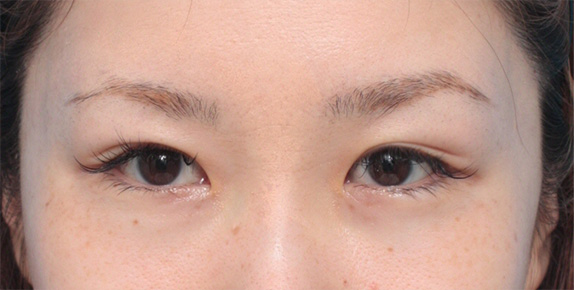 症例写真,狭い末広型二重を埋没法で末広型のまま幅を広げた症例写真,After(目を開いた状態),