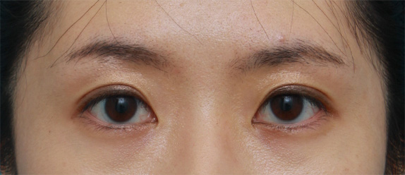 二重まぶた・埋没法,埋没法で自然で似合っている末広型二重を作った症例写真,After(メイクあり)<br/>
(1週間後),