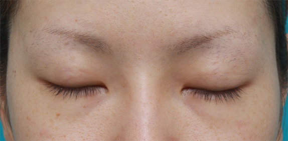 症例写真,埋没法で幅広い平行型二重を作った後、2回目の埋没法で更に幅を広げた症例写真,After(2回目の埋没法術後の目を閉じた状態),