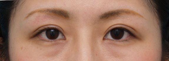 二重まぶた・ミニ切開法(部分切開),ミニ切開二重の症例写真,After(メイクあり)<br/>
(2ヶ月後),