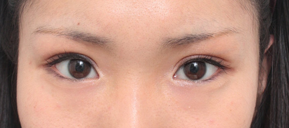 他院で受けた手術の修正(二重まぶた・目もと),埋没法で幅広平行二重にしたが、ミニ切開法でやり直した症例写真,After(メイクあり),