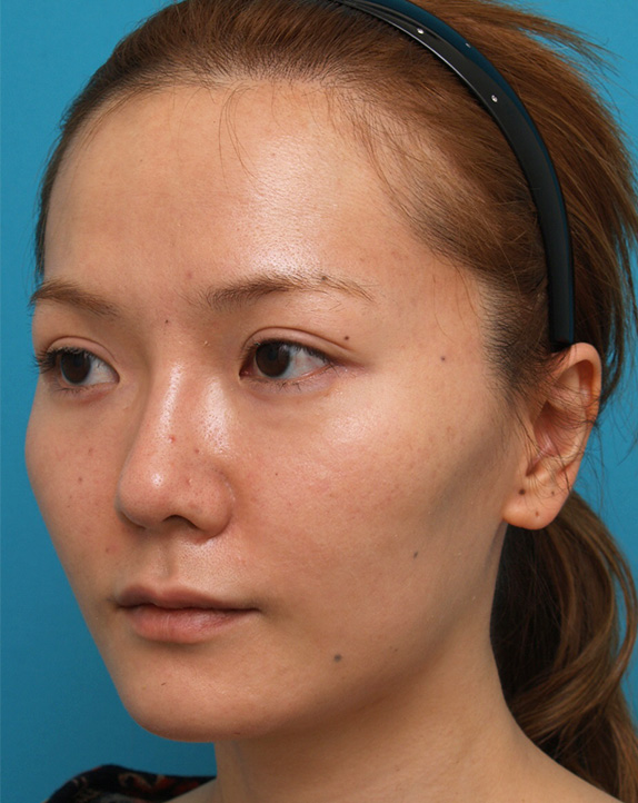 二重まぶた・ミニ切開法(部分切開),ミニ切開二重、金の糸(ゴールデンリフト)、ボツリヌストキシン注射(エラ、プチ小顔術)症例写真,After,ba_minisekkai22_b.jpg