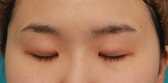 症例写真,蒙古襞が張っている一重まぶたに埋没を行い自然な末広型二重を作った症例写真の術前術後画像,After(目を閉じた状態)<br/>
(1ヶ月後),
