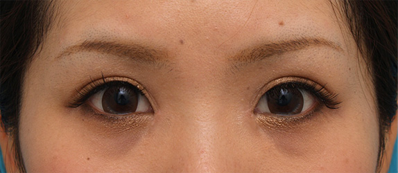 症例写真,ミニ切開二重+目頭切開で狭い平行型二重を作った症例写真,After(メイクあり)<br/>
(3ヶ月後),