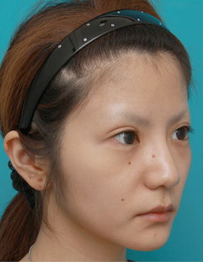 鼻尖形成(鼻尖縮小・だんご鼻修正),ミニ切開二重+目頭切開+鼻プロテーゼ+鼻尖形成+鼻翼縮小症例写真,After(メイクなし),ba_minisekkai25b_b.jpg