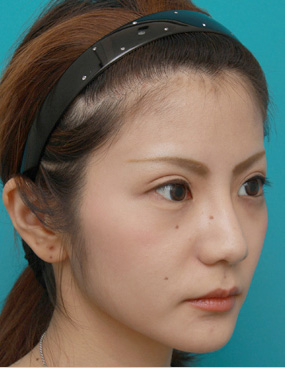 鼻尖形成(鼻尖縮小・だんご鼻修正),ミニ切開二重+目頭切開+鼻プロテーゼ+鼻尖形成+鼻翼縮小症例写真,After(メイクあり),