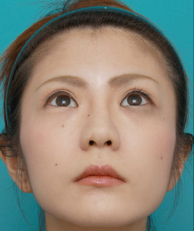 鼻尖形成(鼻尖縮小・だんご鼻修正),ミニ切開二重+目頭切開+鼻プロテーゼ+鼻尖形成+鼻翼縮小症例写真,After(メイクあり),