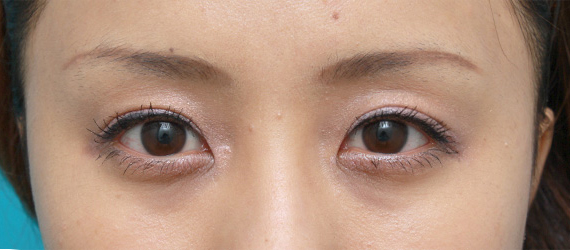 二重まぶた・ミニ切開法(部分切開),一重まぶたに対してミニ切開二重を行い自然な末広型二重を作った症例写真,After(メイクあり)<br/>
(3ヶ月後),